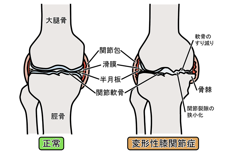 変形性膝関節症画像