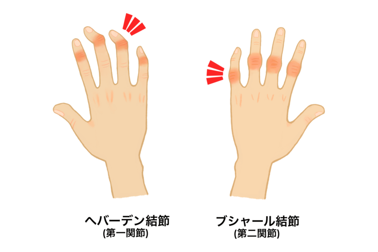 手指変形性関節症（へバーデン結節・ブシャール結節）画像
