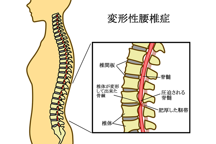 変形性腰椎症、腰部脊柱管狭窄症画像